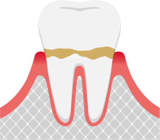 虫歯の前兆